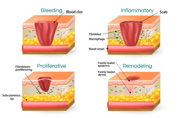Stages Of Wound Healing Elemental Esthetics