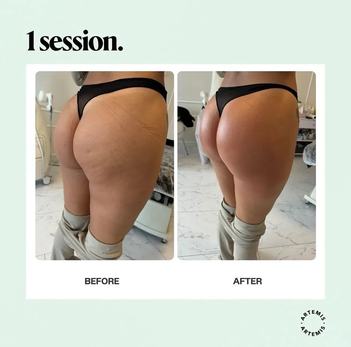 T-Shape 2 legs before-and-after comparison 1 at Elemental Esthetics