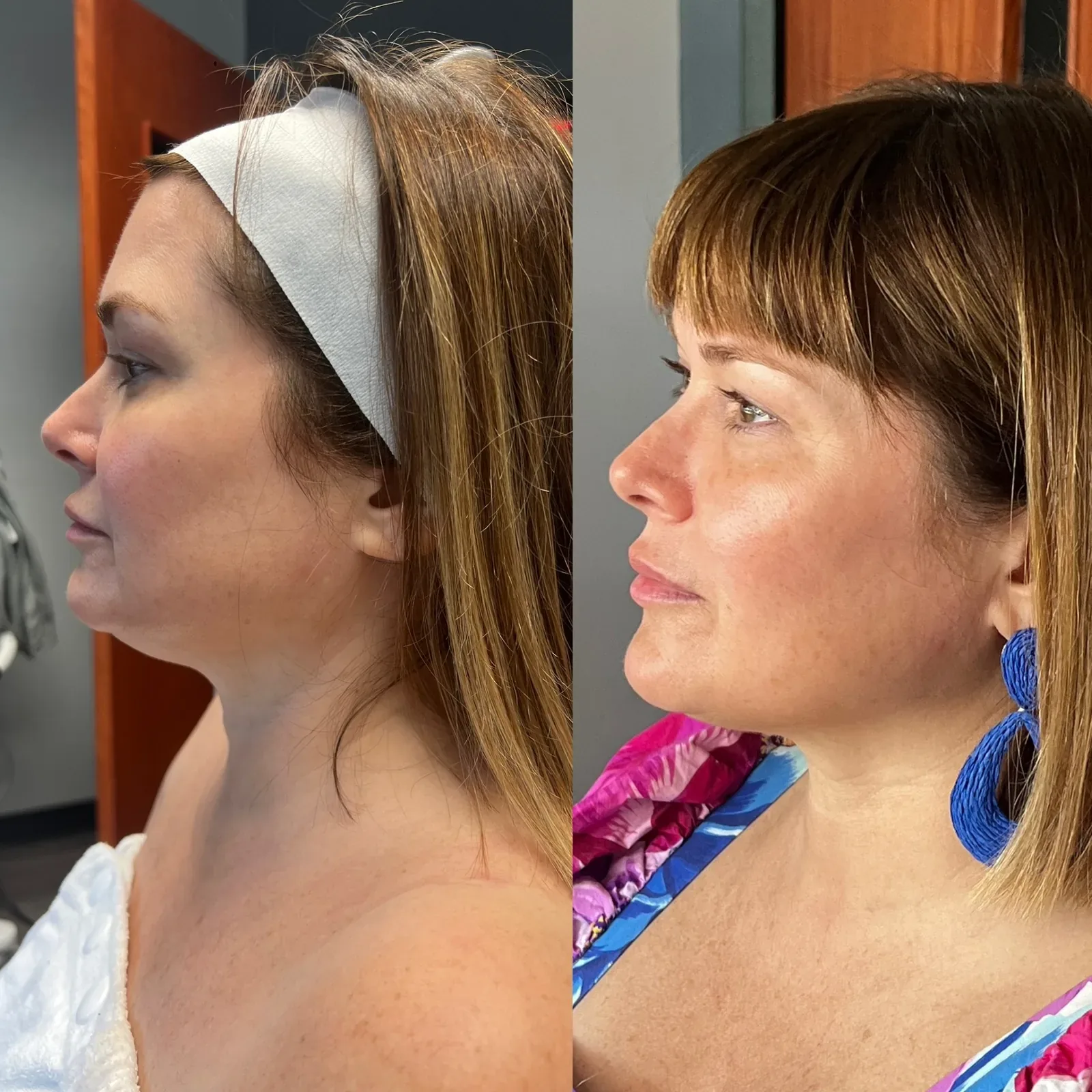 Everesse Monopolar RF client before-and-after comparison 1 at Elemental Esthetics