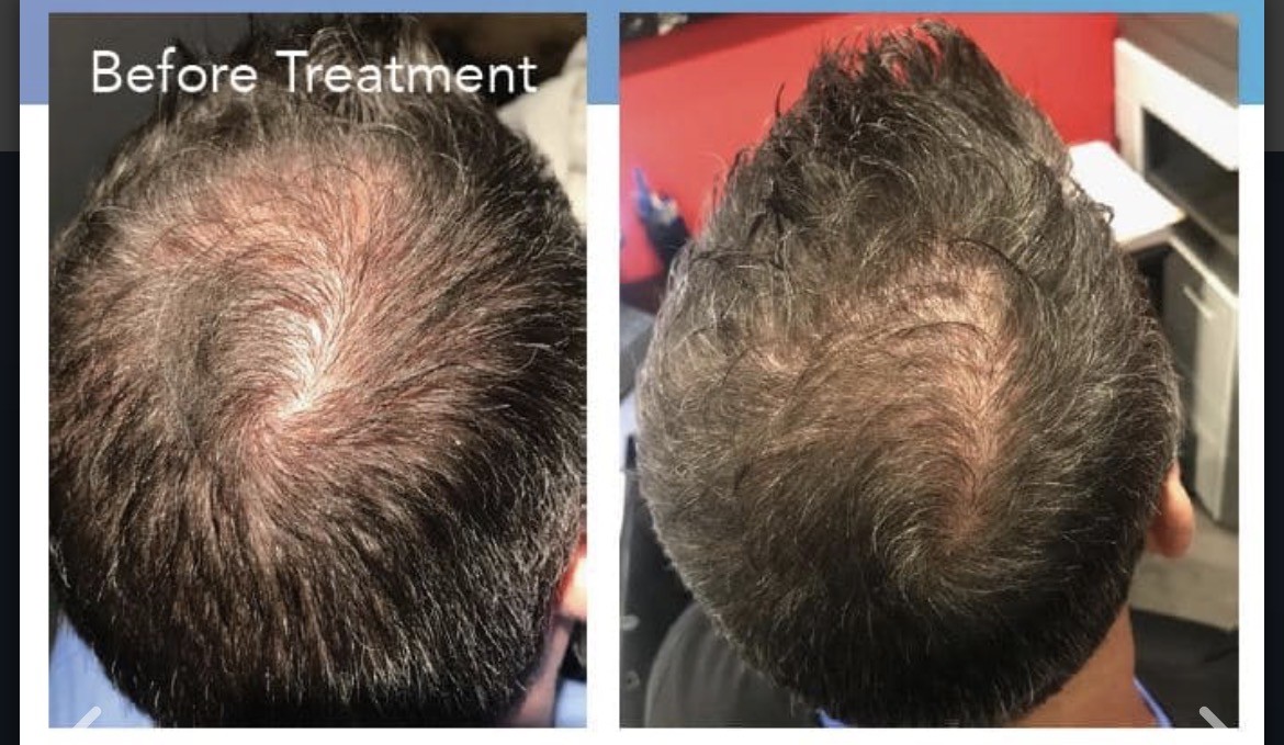 Hair Restoration