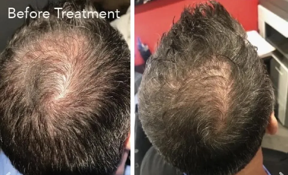 Hair Restoration treatment photo