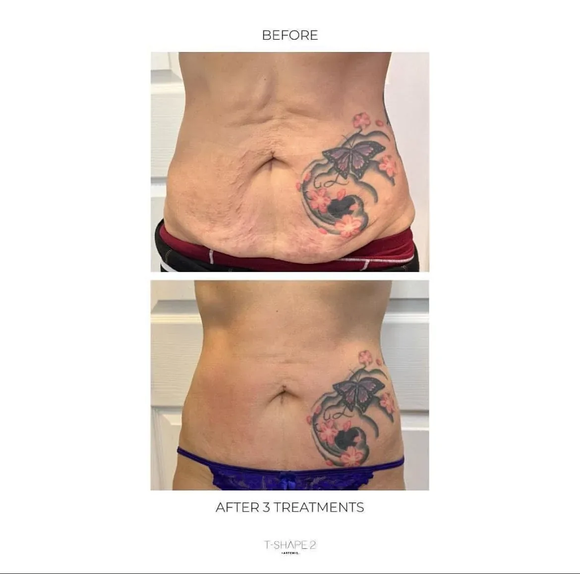 T-Shape 2 abdomen before-and-after comparison 3 at Elemental Esthetics
