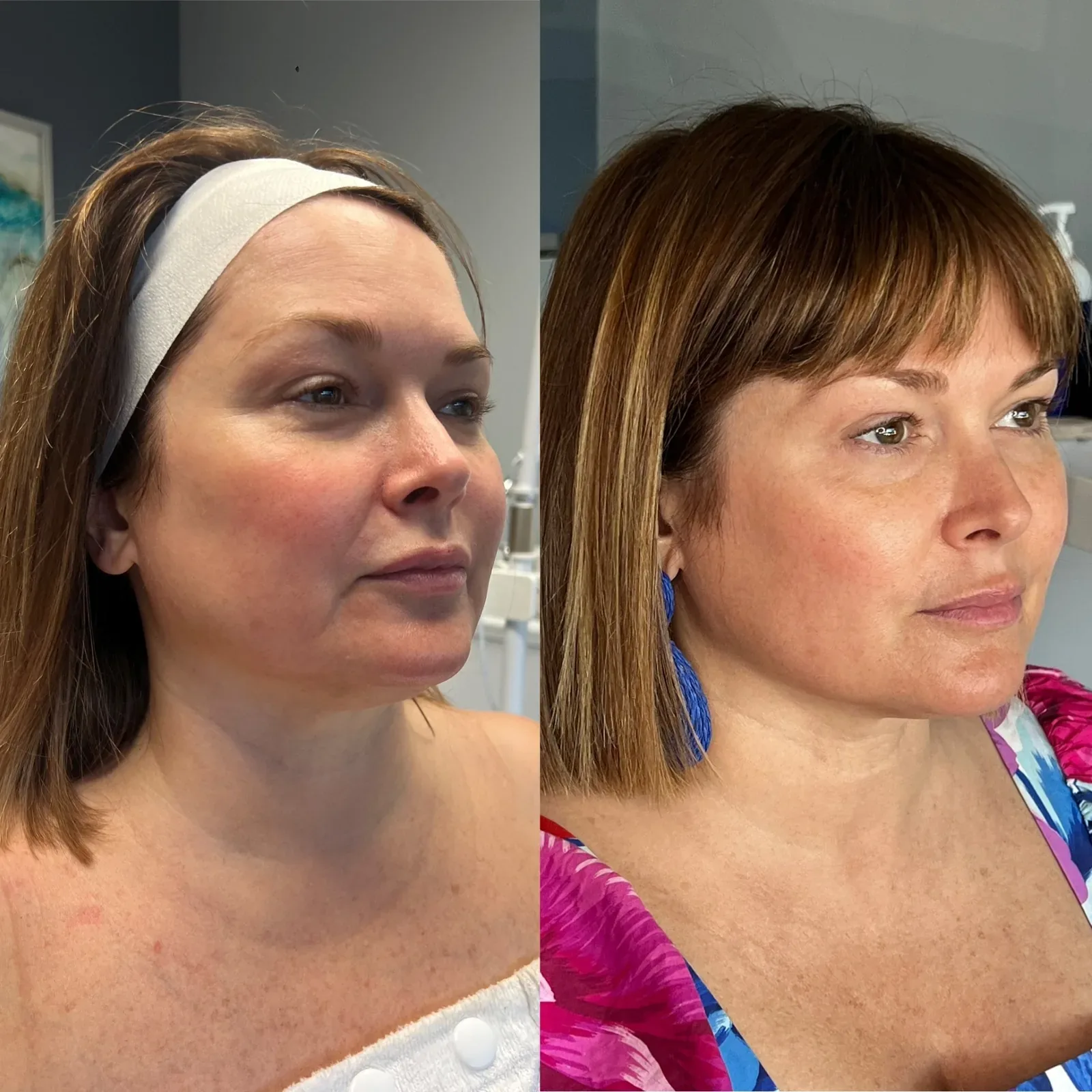 Everesse Monopolar RF client before-and-after comparison 2 at Elemental Esthetics