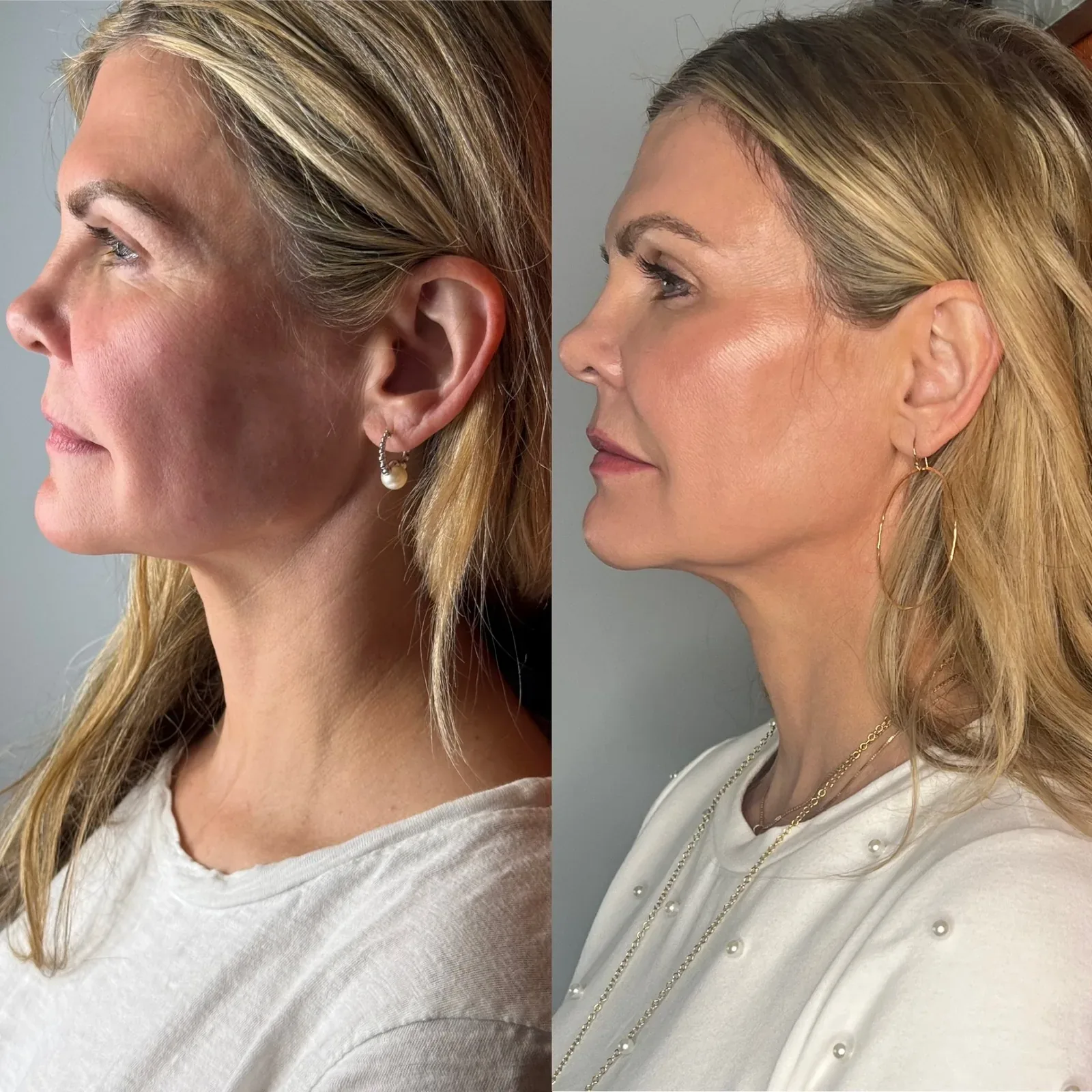 Everesse Monopolar RF client before-and-after comparison 3 at Elemental Esthetics