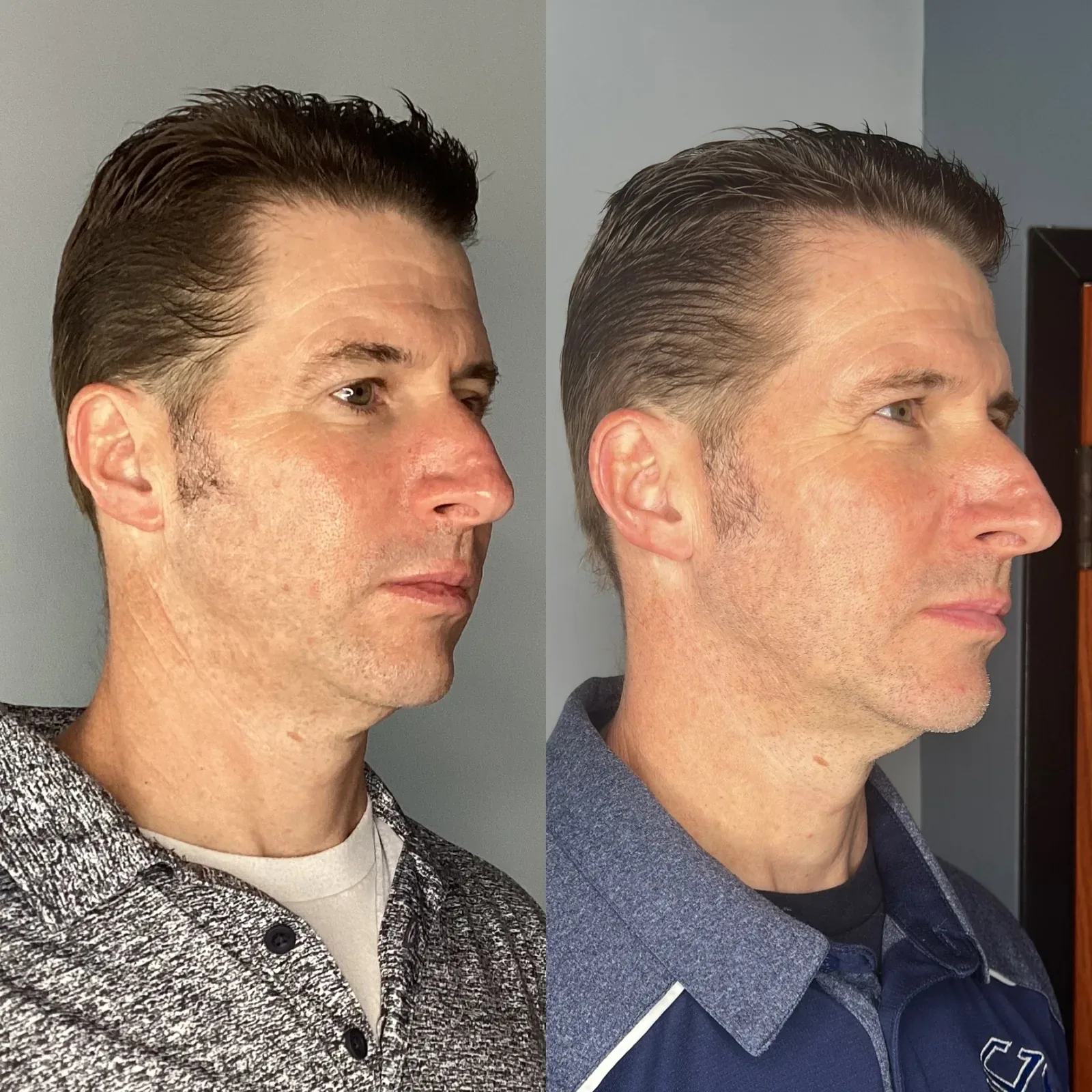 Everesse Monopolar RF client before-and-after comparison 5 at Elemental Esthetics