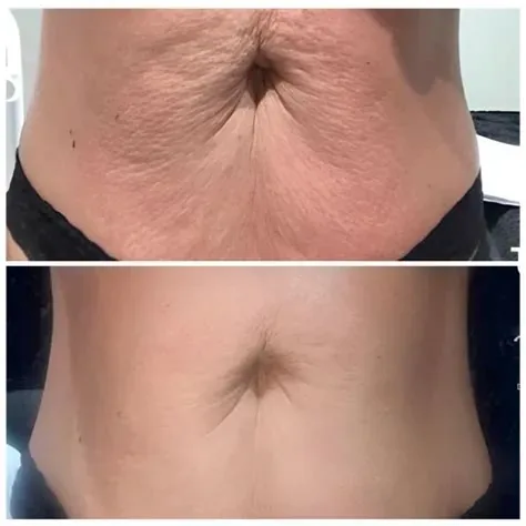 T-Shape 2 abdomen before-and-after comparison 2 at Elemental Esthetics