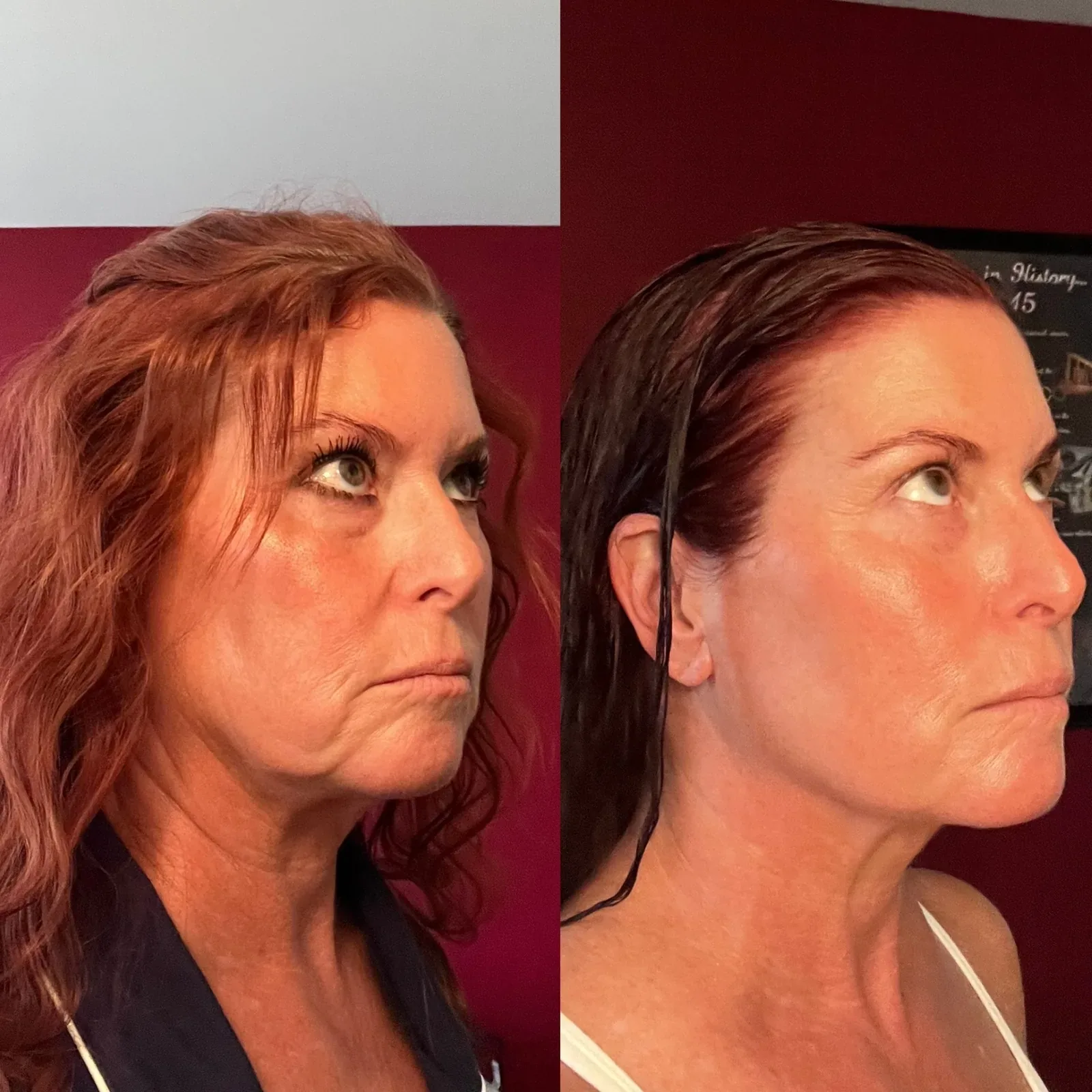 Everesse Monopolar RF client before-and-after comparison 6 at Elemental Esthetics