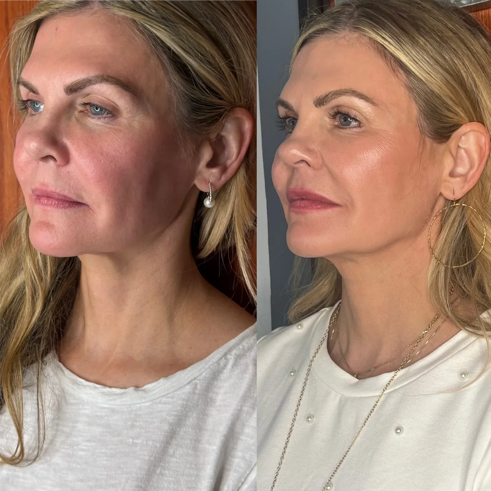 Everesse Monopolar RF client before-and-after comparison 4 at Elemental Esthetics