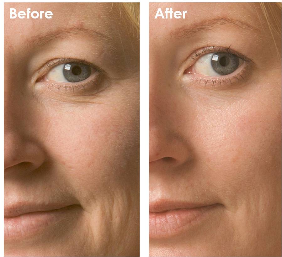 Facial-Before-After