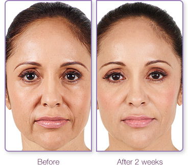 Juvederm XC before after