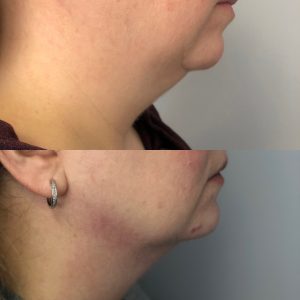 neck-fat-removal