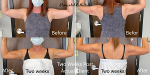 Emsculpt-Arm-Before-After
