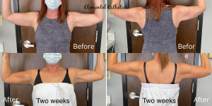 Emsculpt-Arms-Before-After