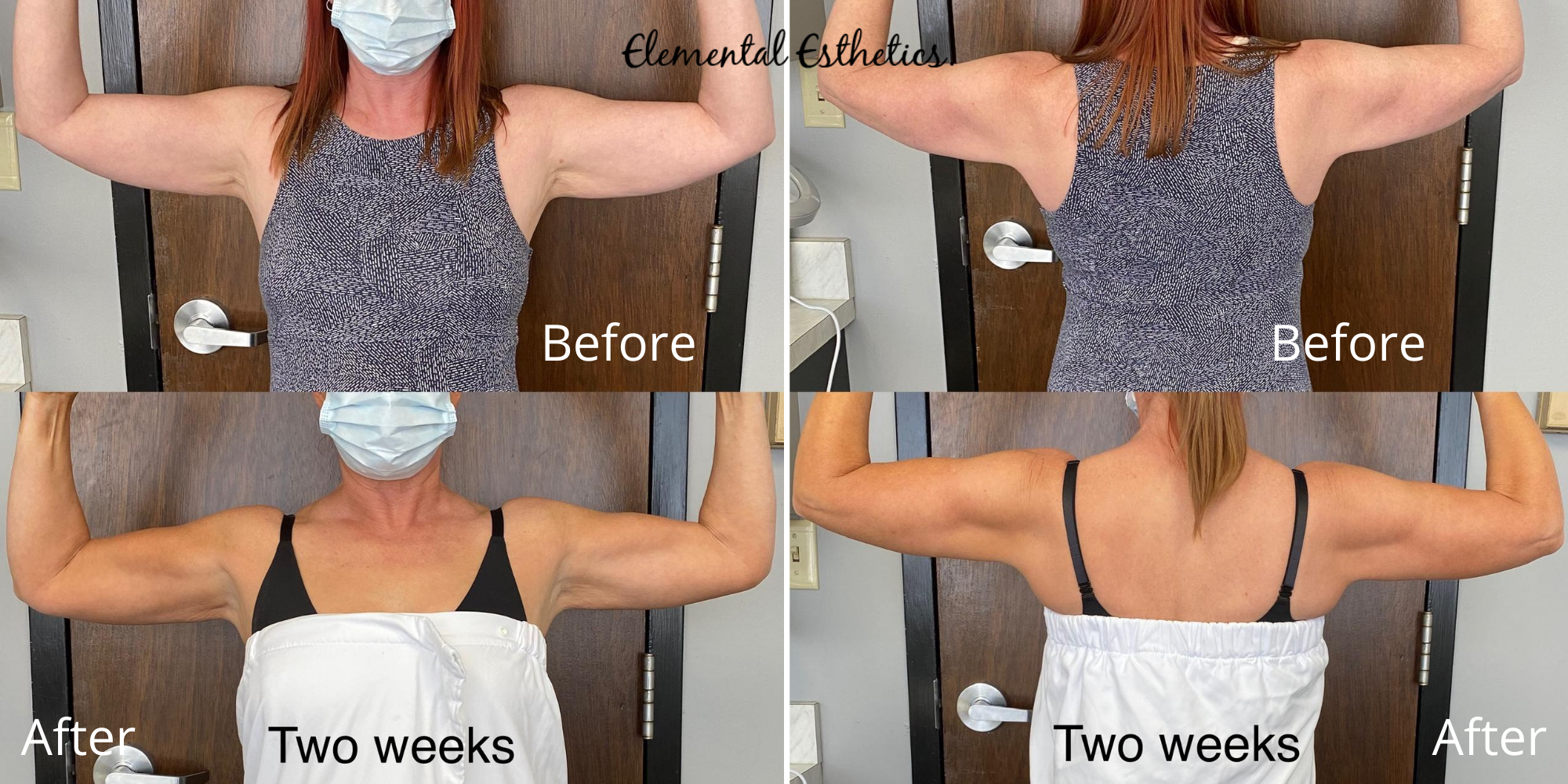 Emsculpt-Arms-Before-After-Pain-Relief