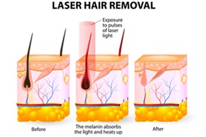 laser-hair-removal-st-louis