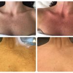 remove-age-spots-from-chest