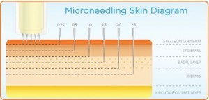 microneedling skin chart