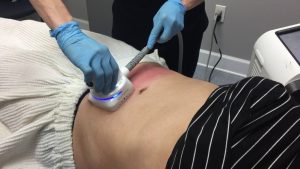 better-than-coolsculpting